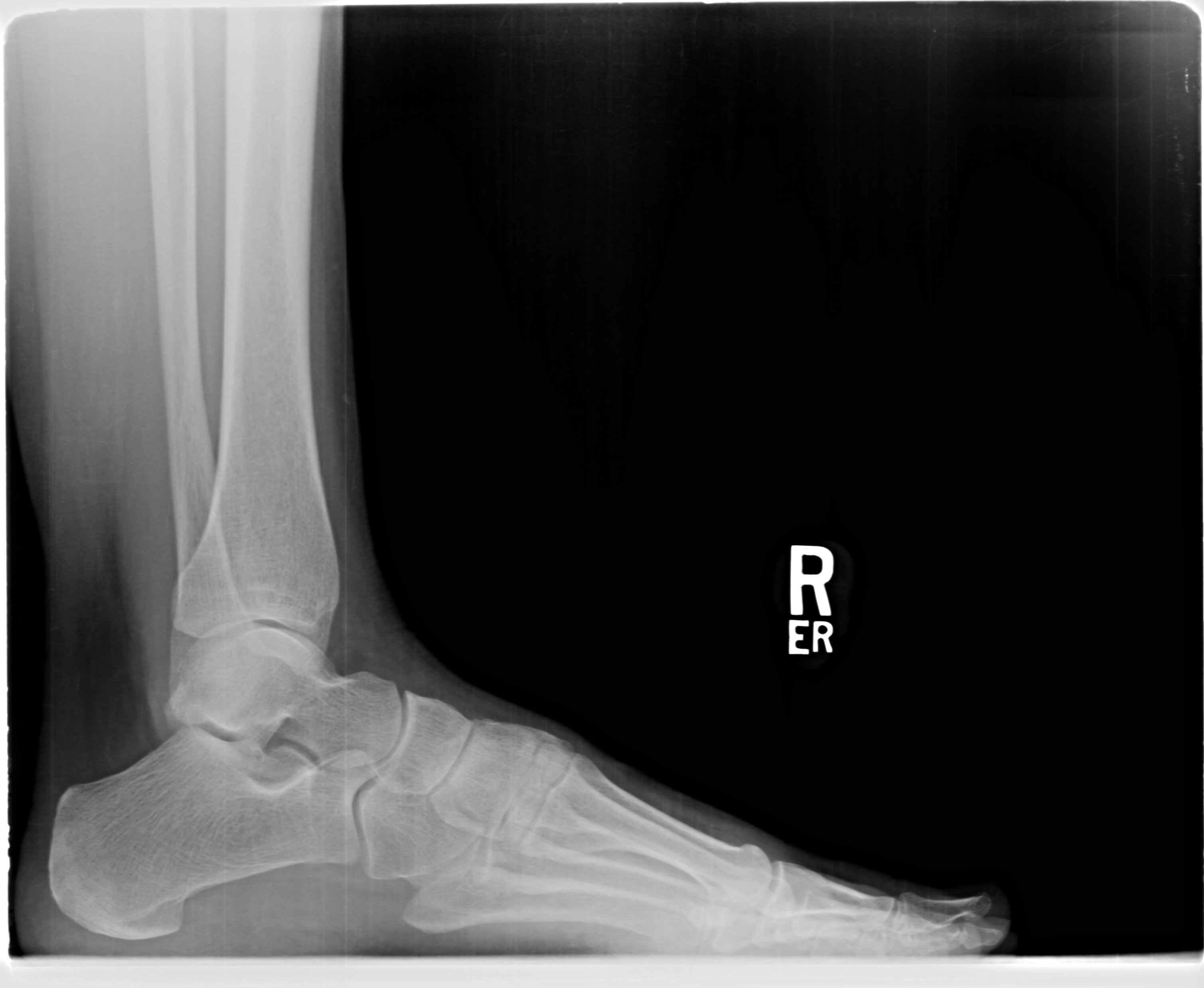 Foot Xray High-Res Stock Photo - Getty Images